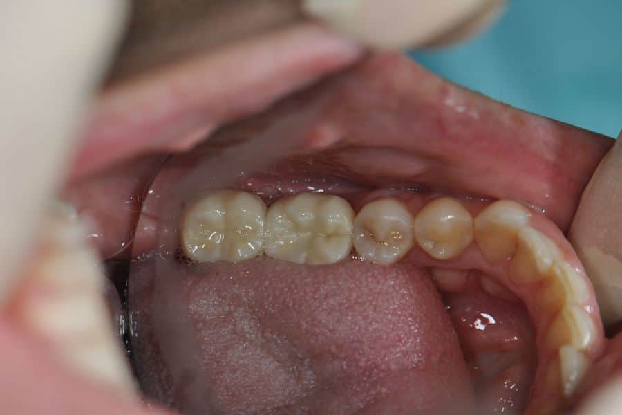 Безметалловые коронки на зубы