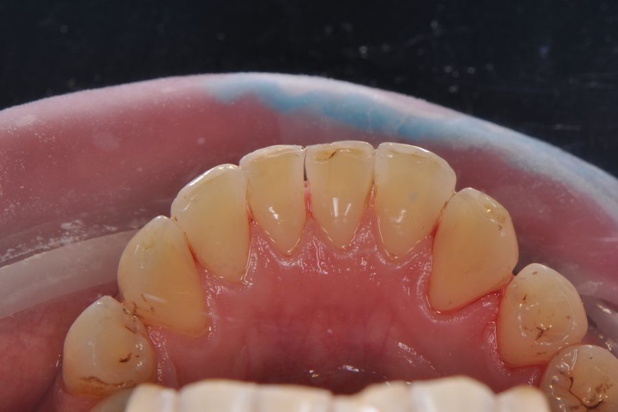 Профилактика кариеса зубов